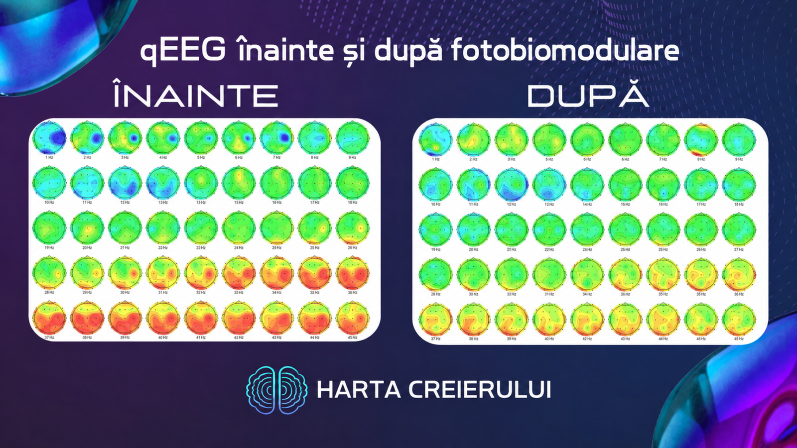 Hartă qEEG înainte și după fotobiomodulare transcraniană – Harta Creierului