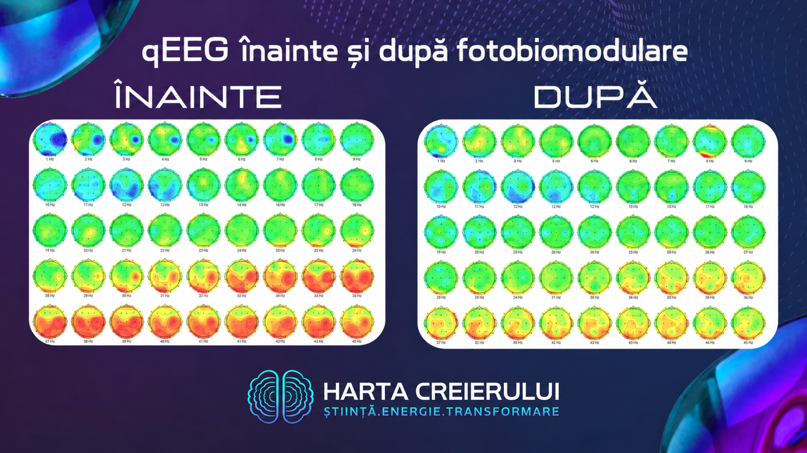Harta qEEG înainte și după Fotobiomodulare – Harta Creierului